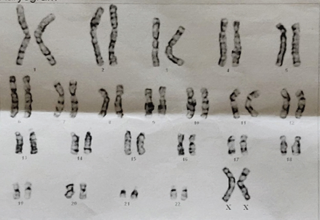 Karyotyping of the child showing 46XX.